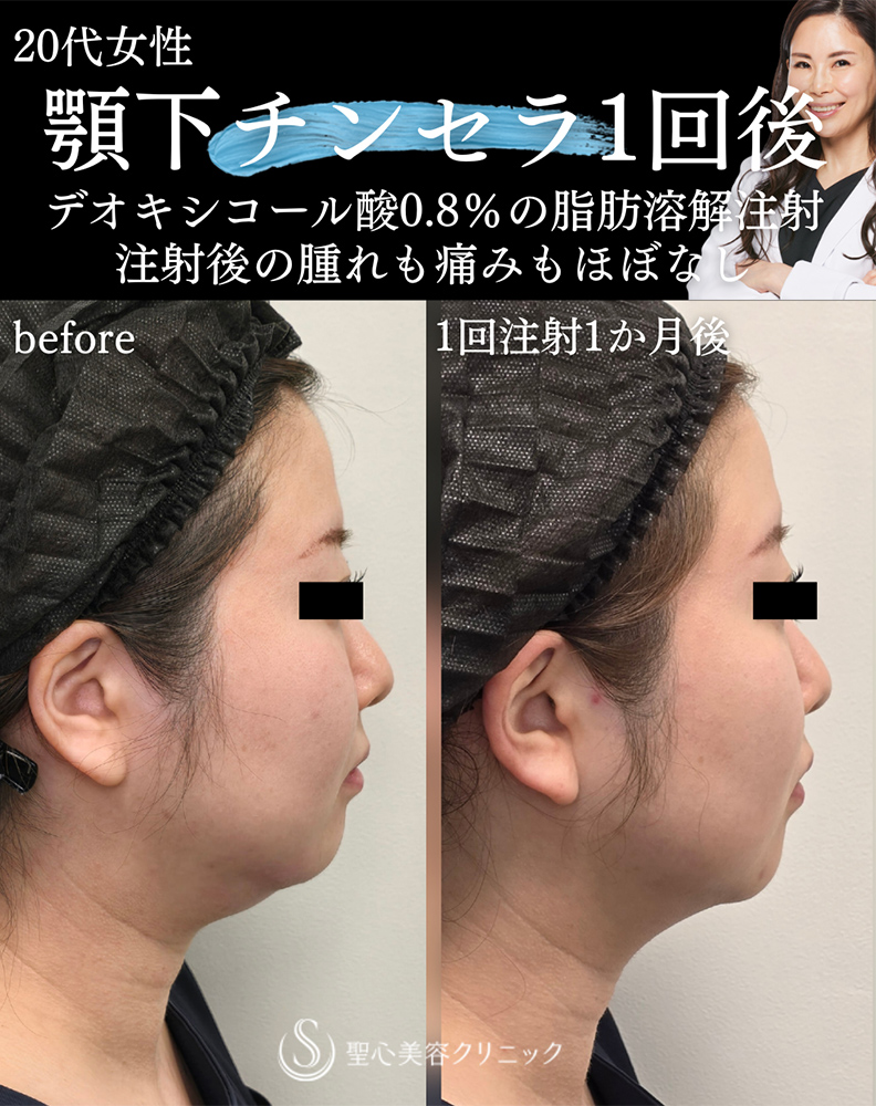 【20代女性・顎下すっきり】チンセラ・プラス（1回）（1ヶ月後） After 