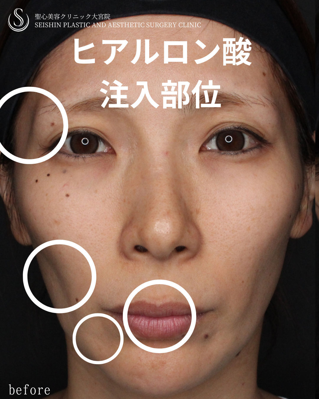 【30代女性・自然に若々しく】トータルフェイシャルトリートメント（1ヶ月後） Before 