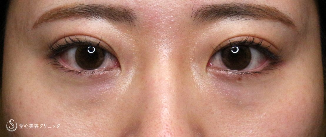 【20代女性・涙袋ヒアルで目を大きく見せる】ヒアルロン酸レスチレン リフトリド（注入直後〜翌日） Before 