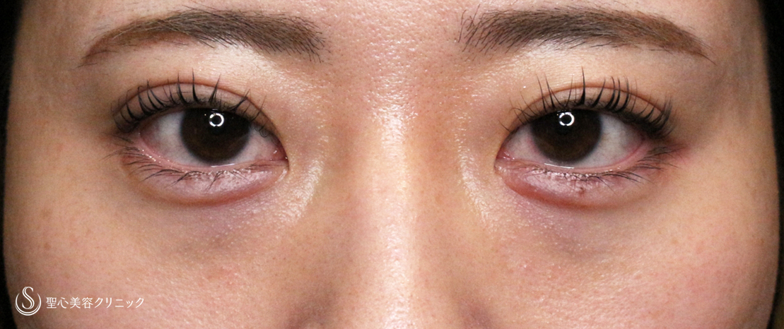 【20代女性・涙袋ヒアルで目を大きく見せる】ヒアルロン酸レスチレン リフトリド（注入直後〜翌日） Before 