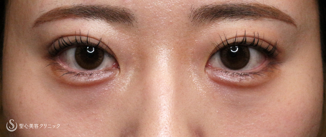 【20代女性・涙袋ヒアルで目を大きく見せる】ヒアルロン酸レスチレン リフトリド（注入直後〜翌日） After 
