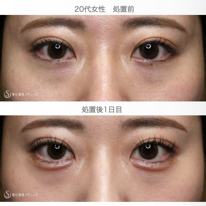 【20代女性・涙袋ヒアルで目を大きく見せる】ヒアルロン酸レスチレン リフトリド（注入直後〜翌日） After 