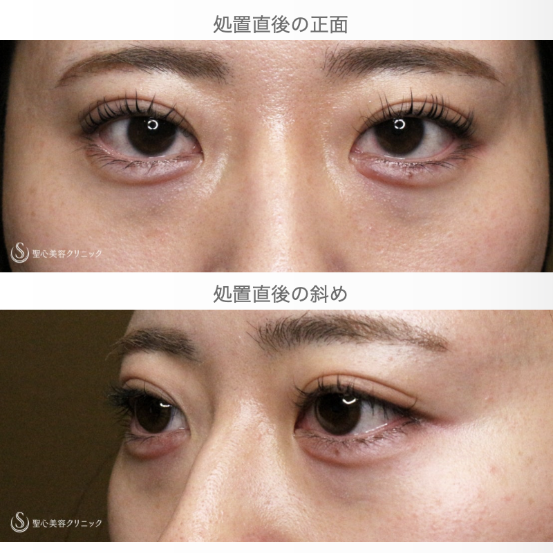 【20代女性・涙袋ヒアルで目を大きく見せる】ヒアルロン酸レスチレン リフトリド（注入直後〜翌日） After 
