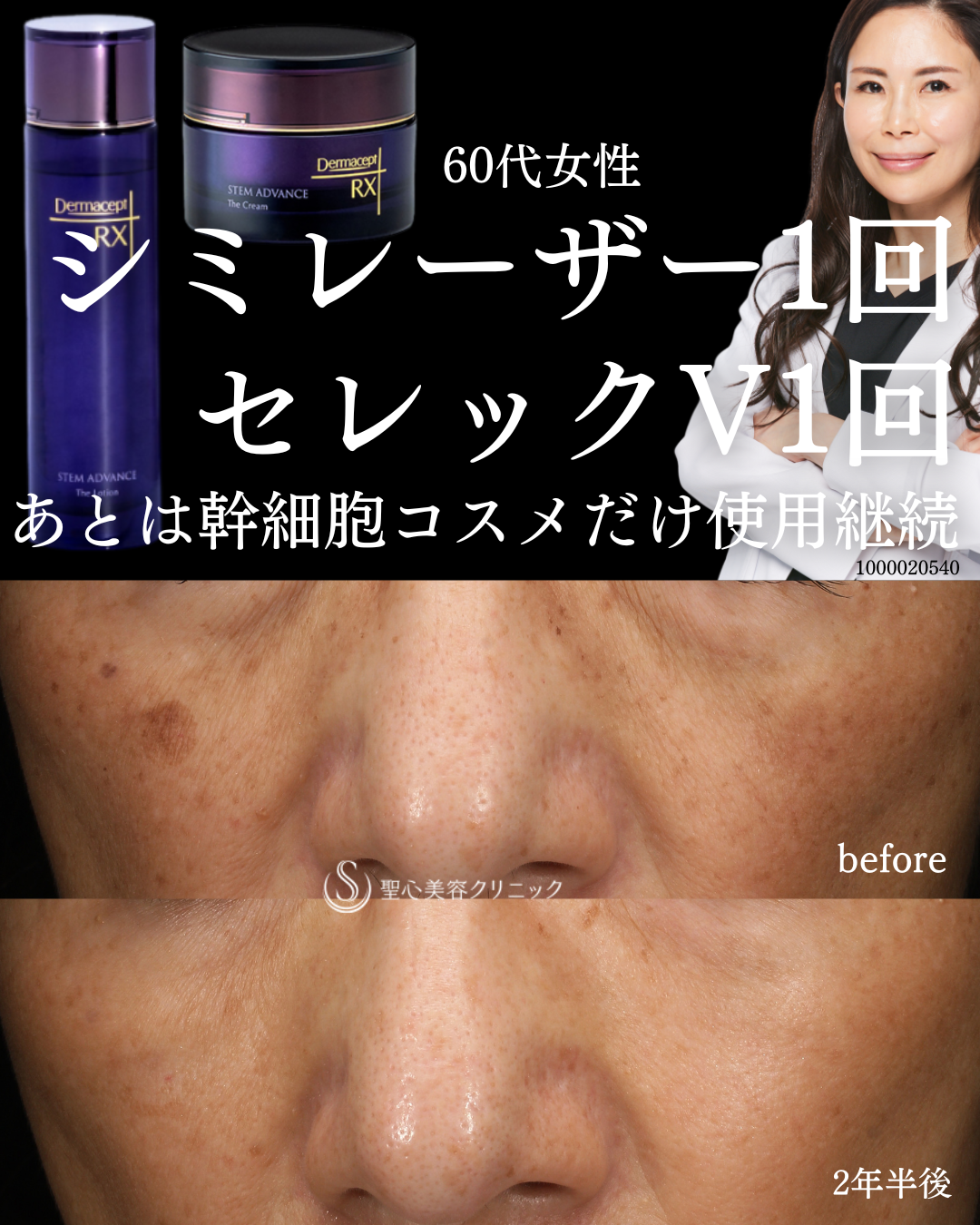 【60代女性・美しい肌をキープ】セレック1回＋シミレーザー1回＋幹細胞コスメ（継続2年半） After 