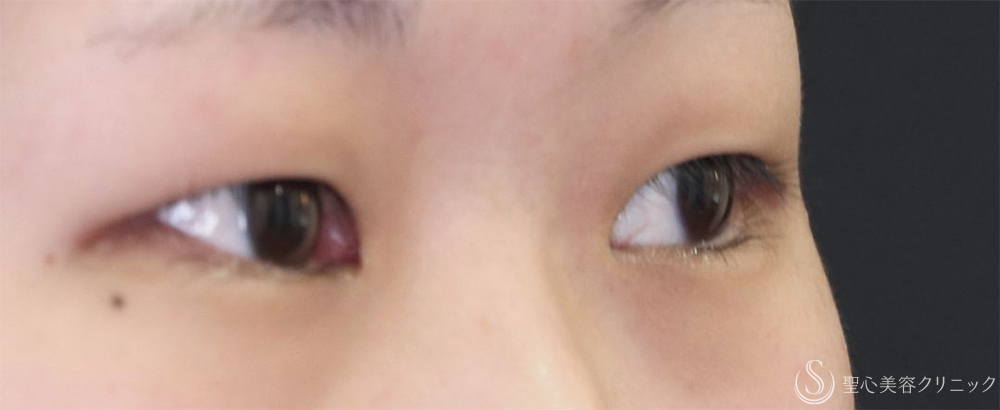 【20代女性・自然な二重切開】二重切開＋脱脂術（1週間後～1ヶ月後） Before 