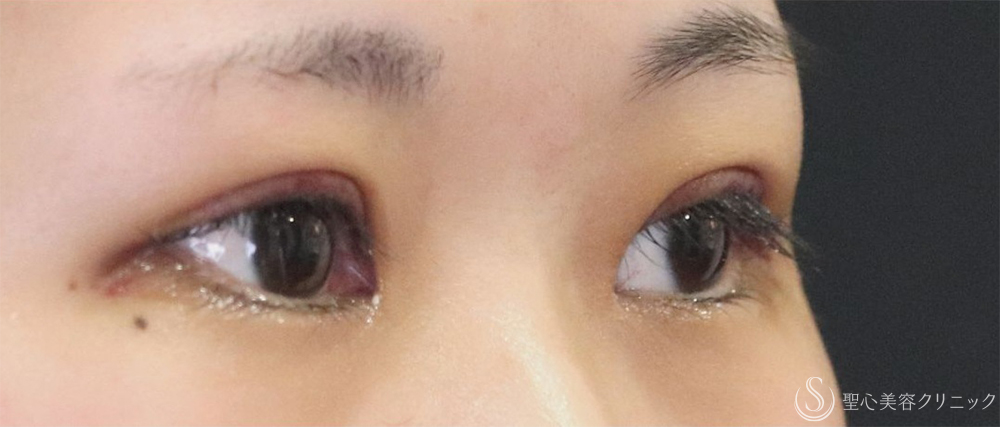 【20代女性・自然な二重切開】二重切開＋脱脂術（1週間後～1ヶ月後） After 
