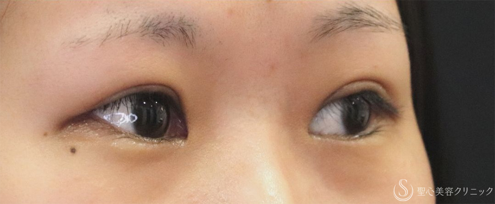 【20代女性・自然な二重切開】二重切開＋脱脂術（1週間後～1ヶ月後） After 