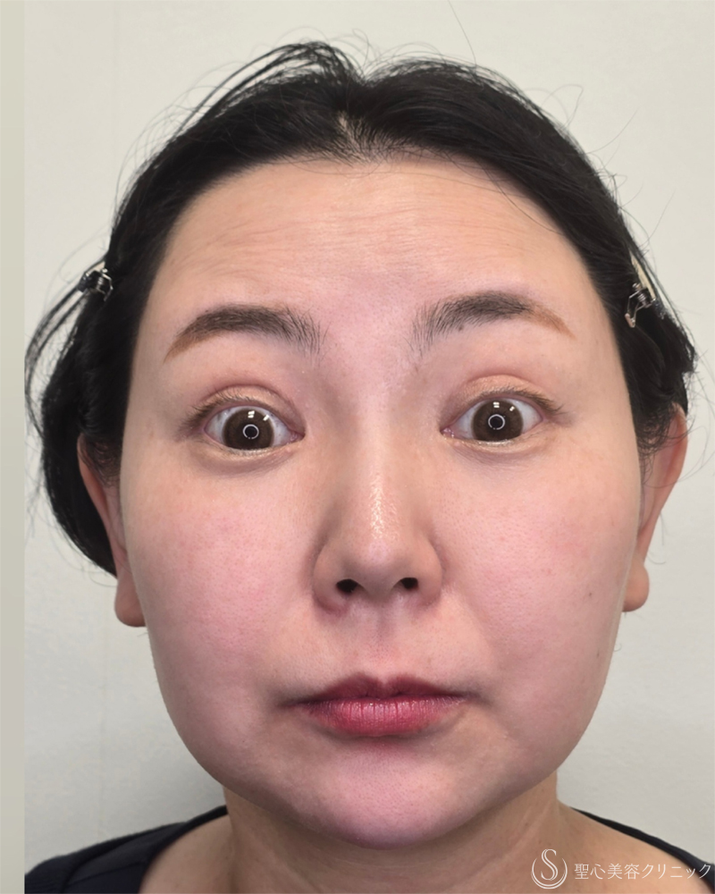 40代女性・額のシワをなくしつやつやおでこに】ボトックス注入（2週間後）