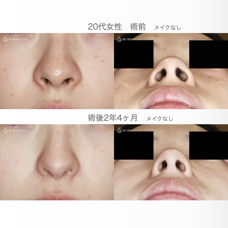 【20代女性・外側切開なしで忘れ鼻】小鼻縮小術+α法「Ver.7」単独（術直後〜2年4ヶ月後） After 
