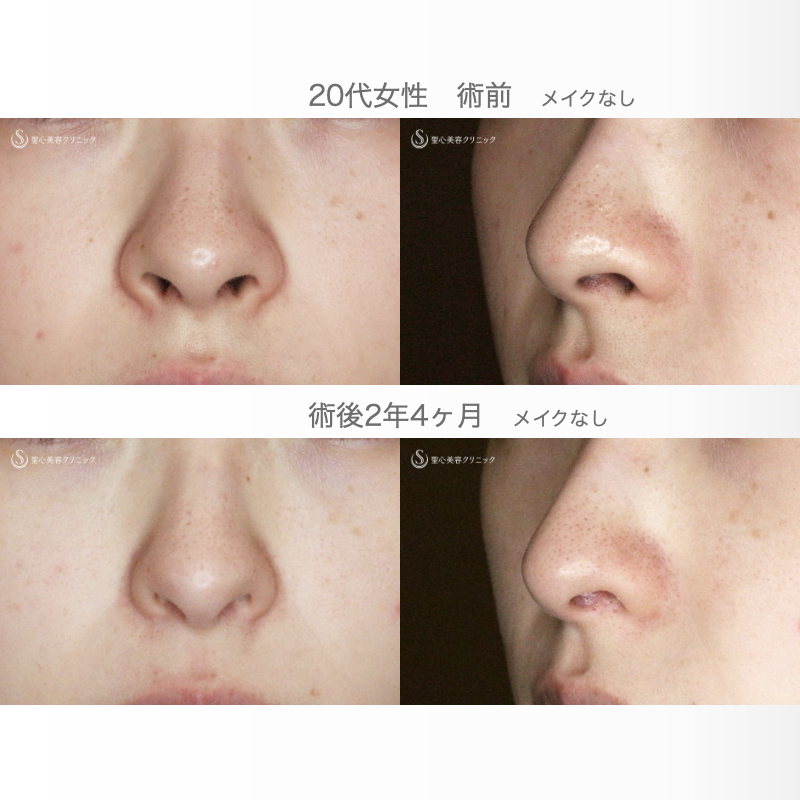 【20代女性・外側切開なしで忘れ鼻】小鼻縮小術+α法「Ver.7」単独（術直後〜2年4ヶ月後） After 