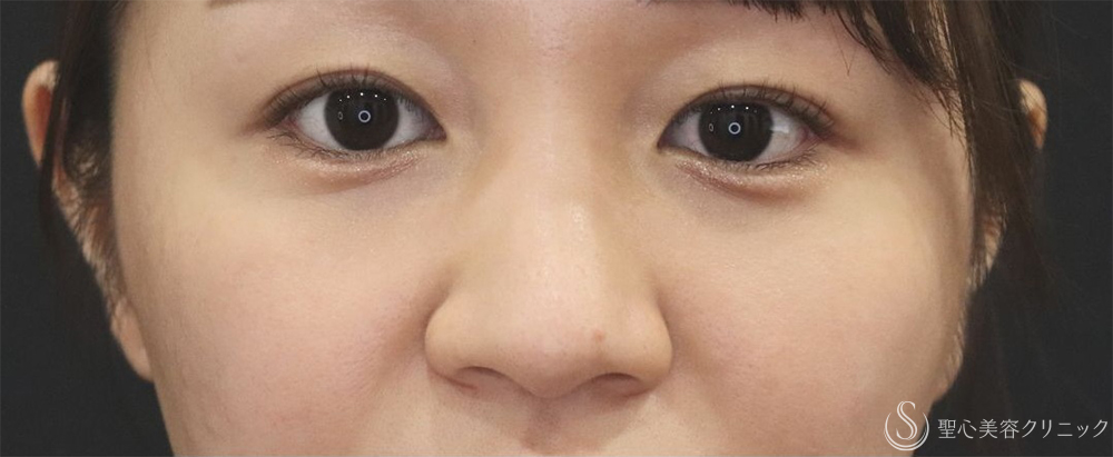 【20代女性・自然な小鼻へ】小鼻縮小（6日後～2ヶ月後） Before 