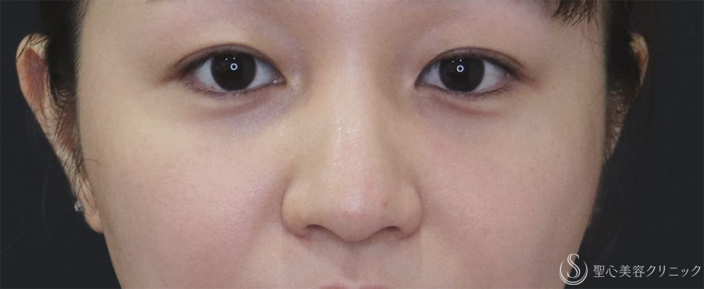 【20代女性・自然な小鼻へ】小鼻縮小（6日後～2ヶ月後） After 