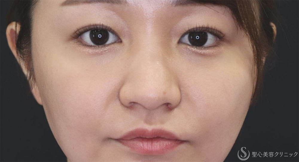 【20代女性・自然な小鼻へ】小鼻縮小（6日後～2ヶ月後） After 