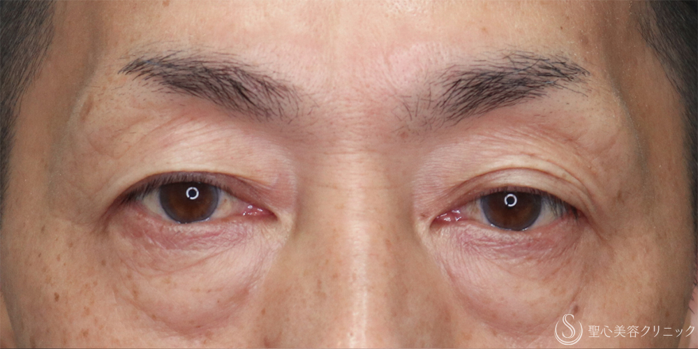 【50代男性・目の下を自然にすっきり】下眼瞼除皺術＋脂肪取り（3ヶ月後） Before 