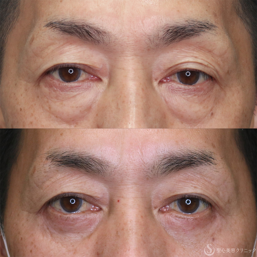 【50代男性・目の下を自然にすっきり】下眼瞼除皺術＋脂肪取り（3ヶ月後） After 名古屋・たるみ取り・アンチエイジング