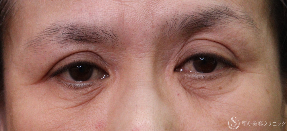 【50代女性・目の下のしわ】プレミアムPRP皮膚再生療法（3ヶ月後） Before 