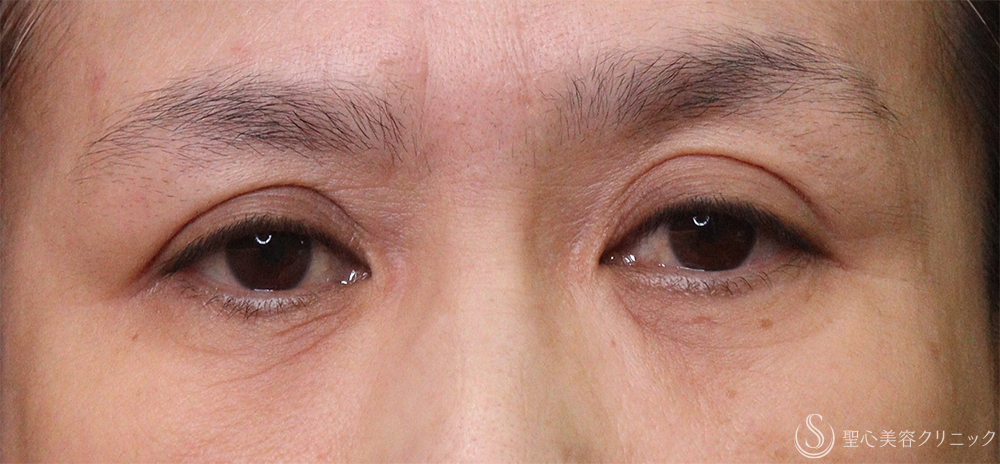 【50代女性・目の下のしわ】プレミアムPRP皮膚再生療法（3ヶ月後） After 
