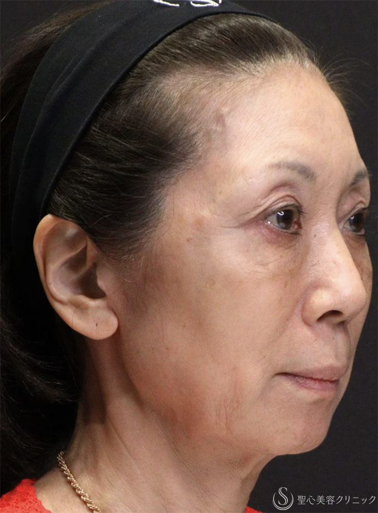 【60代女性・自然で若々しい】トータルフェイシャルトリートメント（直後） Before 