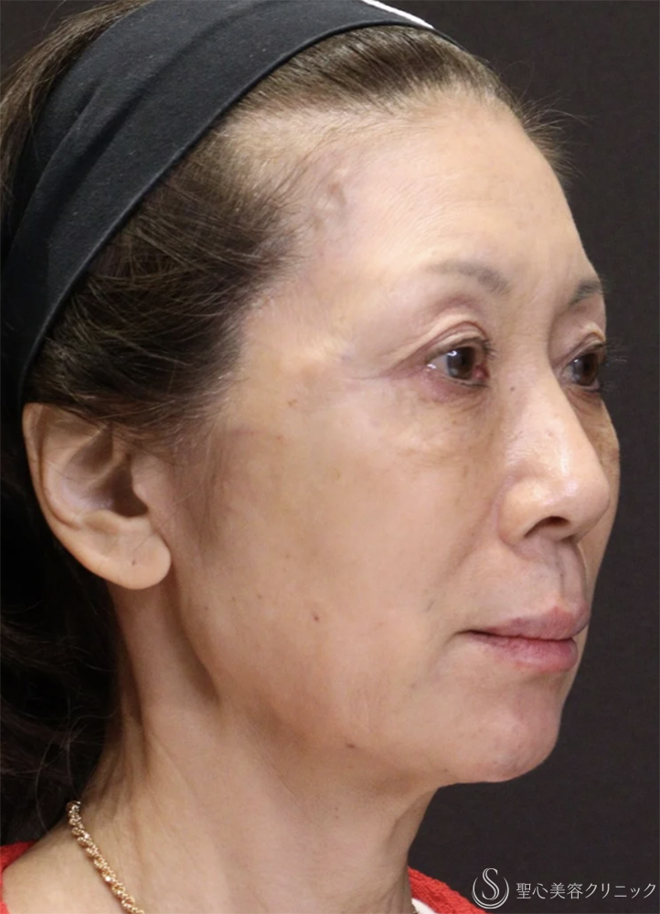 【60代女性・自然で若々しい】トータルフェイシャルトリートメント（直後） After 