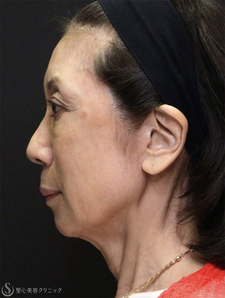 【60代女性・自然で若々しい】トータルフェイシャルトリートメント（直後） Before 