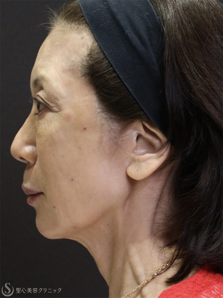 【60代女性・自然で若々しい】トータルフェイシャルトリートメント（直後） After 