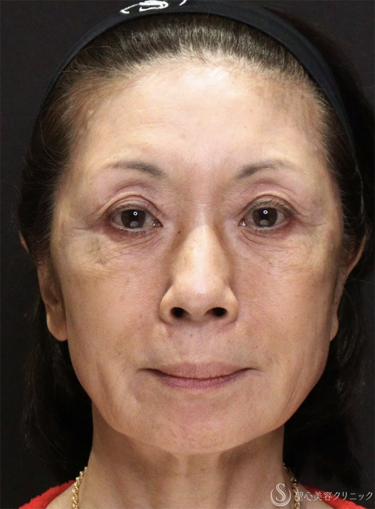 【60代女性・自然で若々しい】トータルフェイシャルトリートメント（直後） Before 