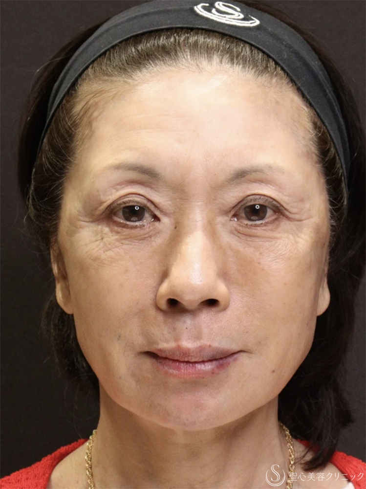 【60代女性・自然で若々しい】トータルフェイシャルトリートメント（直後） After 