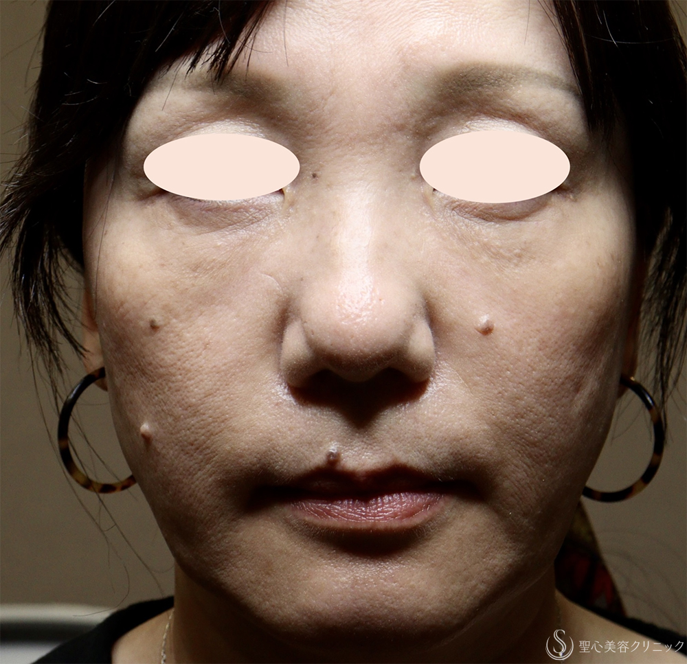 【50代女性・顔全体若返り】プレミアムPRP皮膚再生療法（半年後） After 