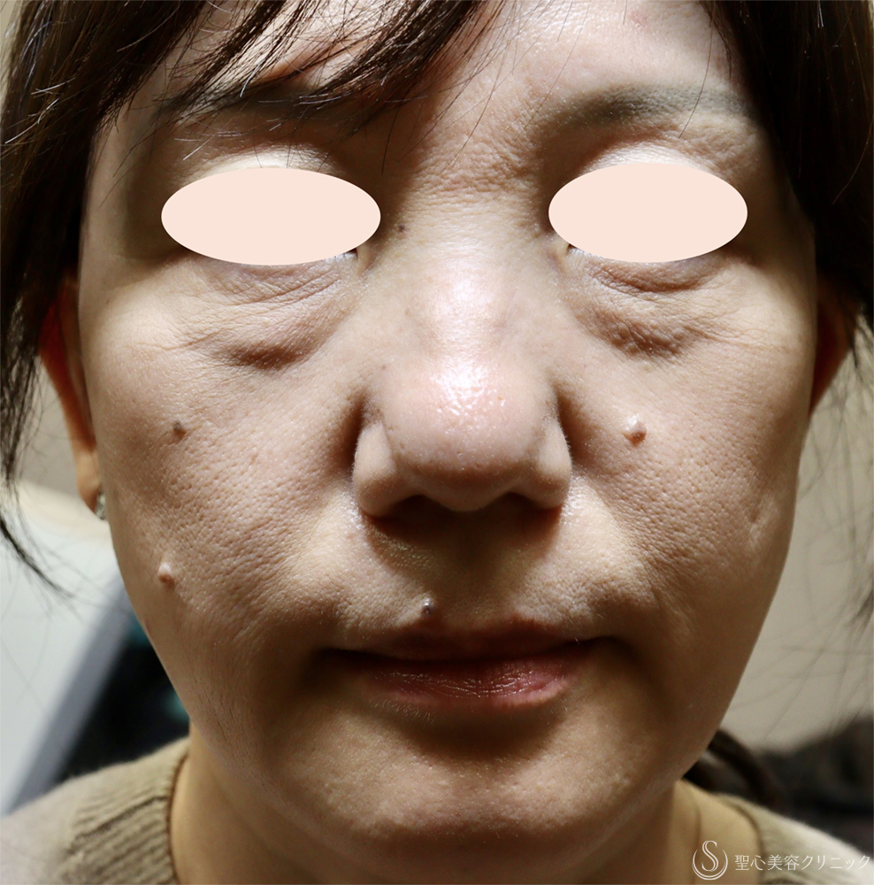 【50代女性・顔全体若返り】プレミアムPRP皮膚再生療法（半年後） Before 