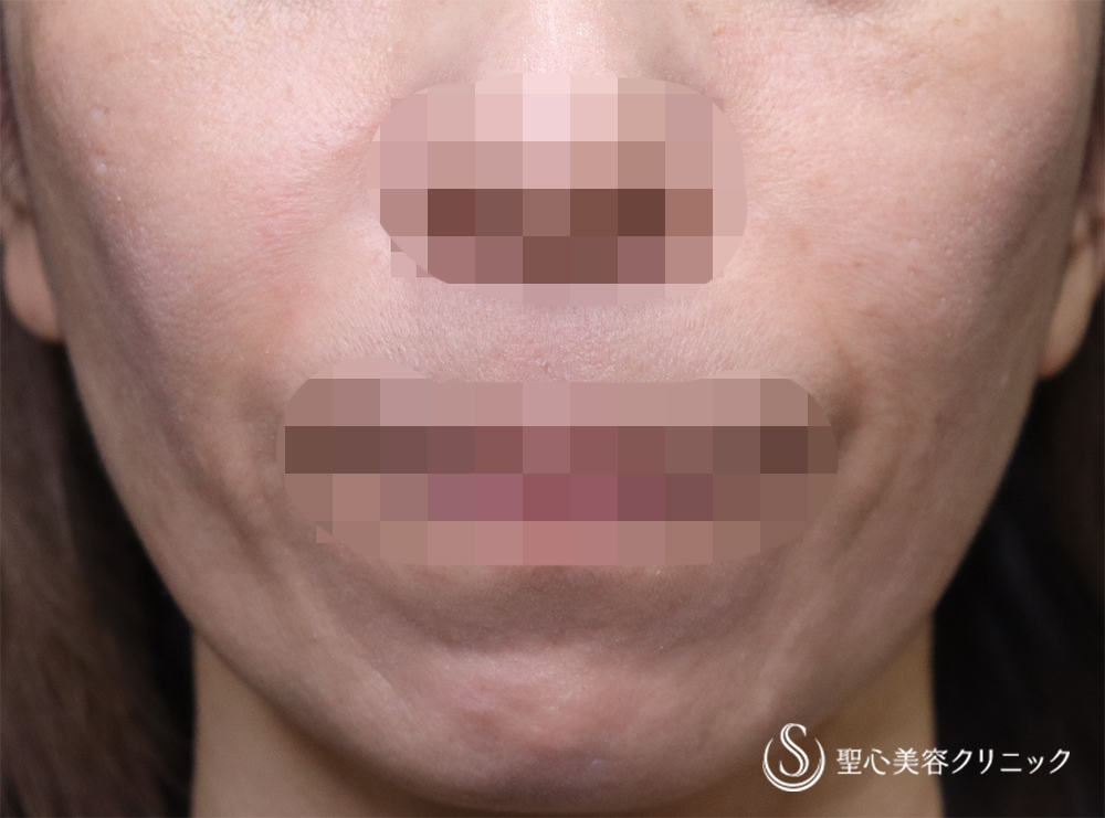 【40代女性・ほうれい線の若返り】プレミアムPRP皮膚再生療法（4ヶ月後） After 