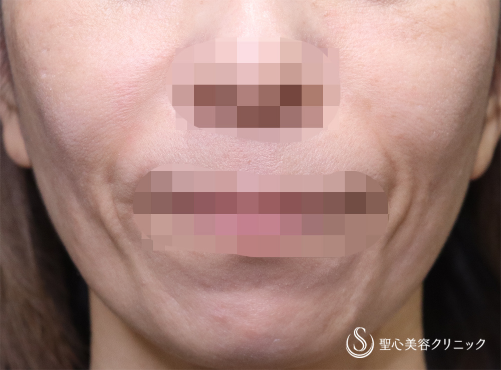 【40代女性・ほうれい線の若返り】プレミアムPRP皮膚再生療法（4ヶ月後） After 