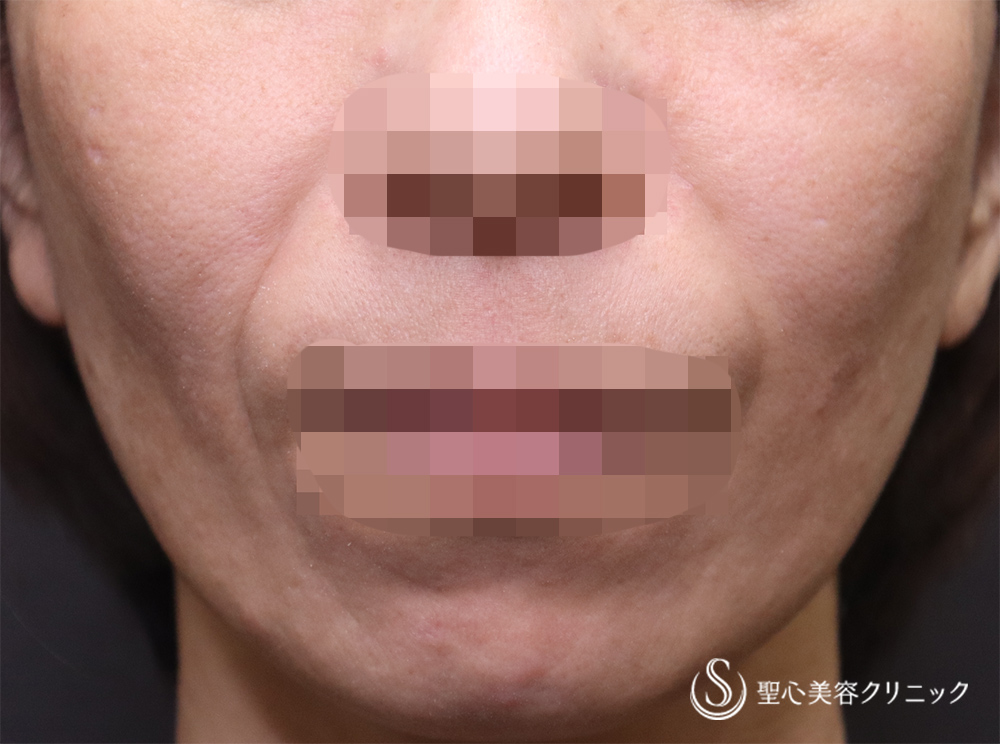 【40代女性・ほうれい線の若返り】プレミアムPRP皮膚再生療法（4ヶ月後） Before 