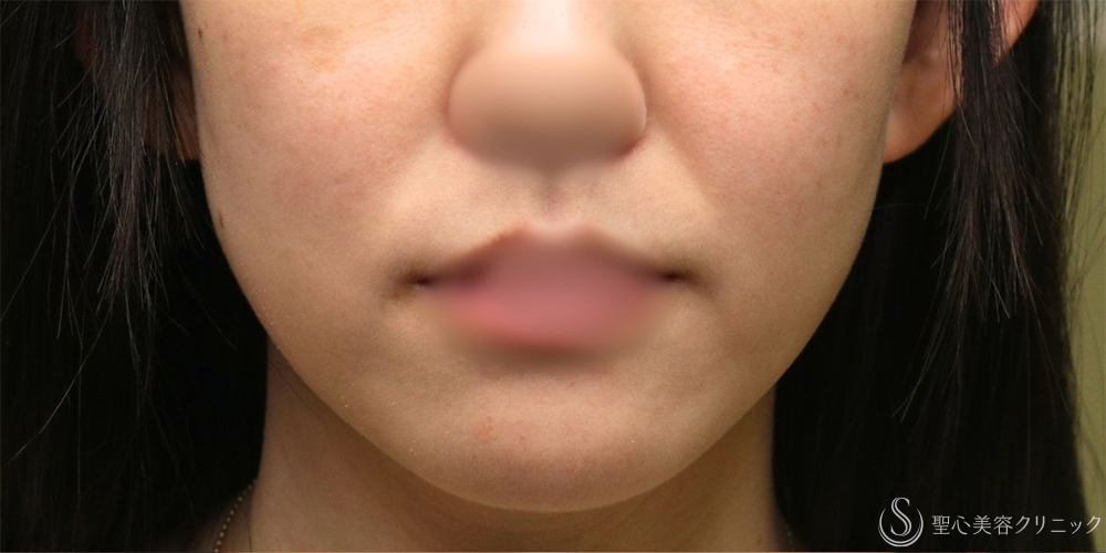 【30代女性・ほうれい線のしわ改善長期経過】プレミアムPRP皮膚再生療法（2年後） Before 
