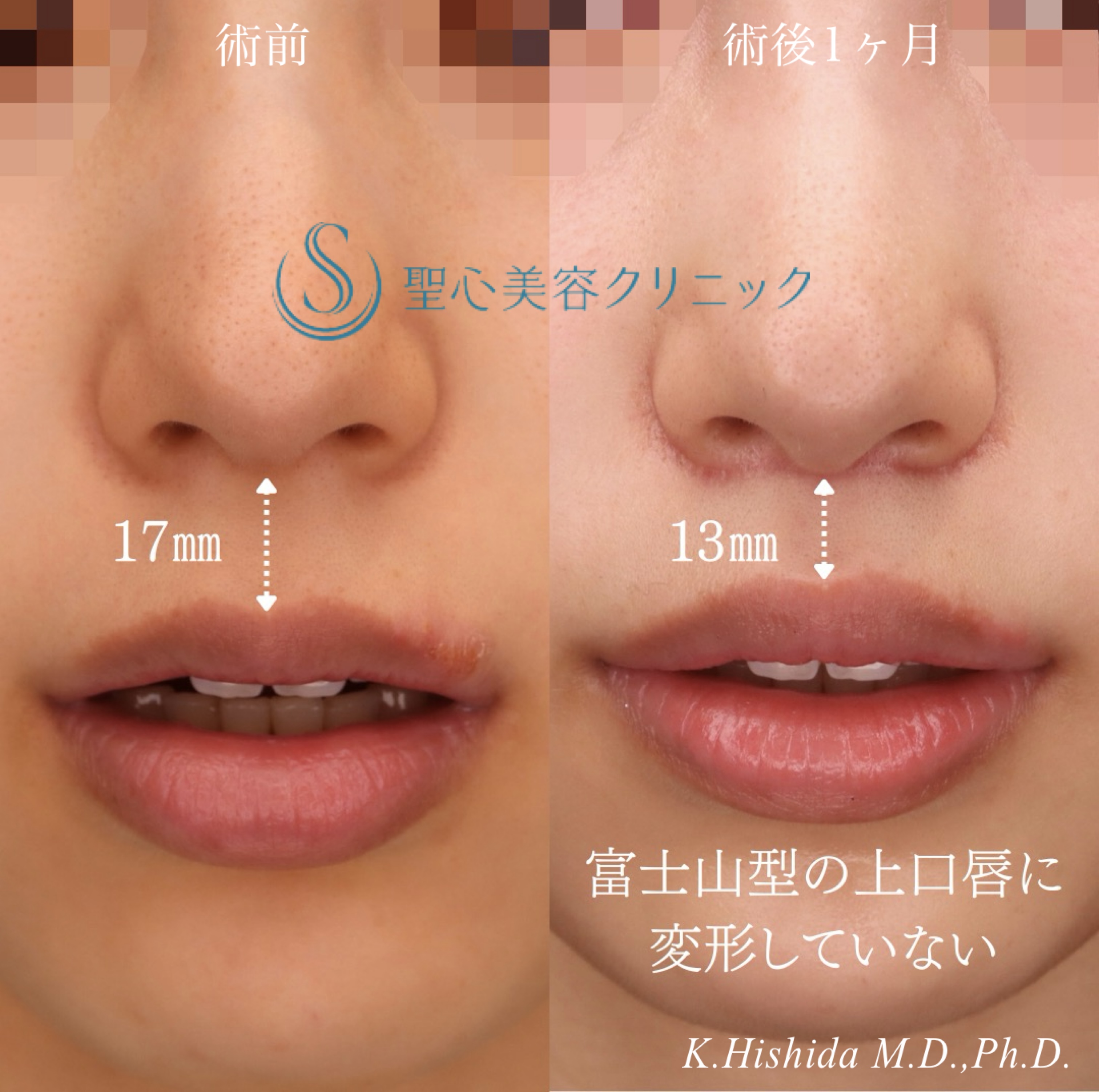 【20代女性・口元のバランスを可愛く整えたい！！】プレミアムリップリフト（プレミアム人中短縮術）（1ヶ月後） After 