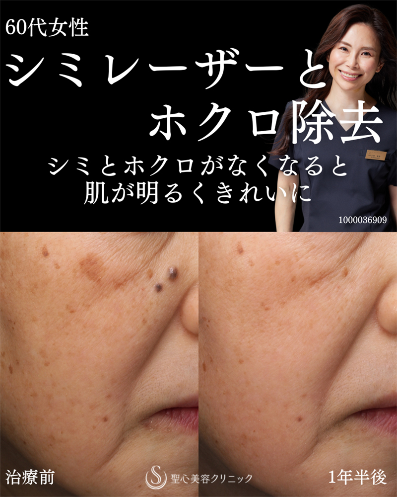 【60代女性・シミレーザーとホクロ除去できれいな肌に】しみ・アザ取りレーザー＋ホクロ・イボ（1年半後） After 