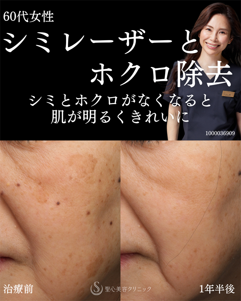 【60代女性・シミレーザーとホクロ除去できれいな肌に】しみ・アザ取りレーザー＋ホクロ・イボ（1年半後） After 