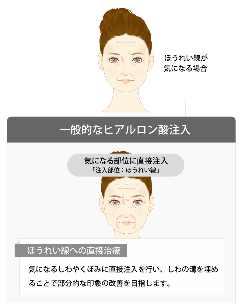 一般的なヒアルロン酸注入