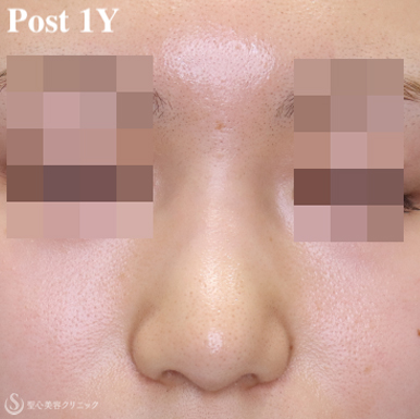 【20代女性・鼻先の丸みをスッキリ解消】鼻尖縮小術＋α法（術後1年） After 