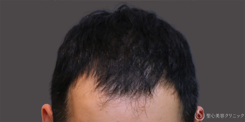 【30代男性・毛髪治療の長期経過】プレミアムグロースファクター再生療法＋デュタステリドAV＋ノキシジル内服（10ヶ月後～7年後） After 名古屋・AGA治療・発毛治療