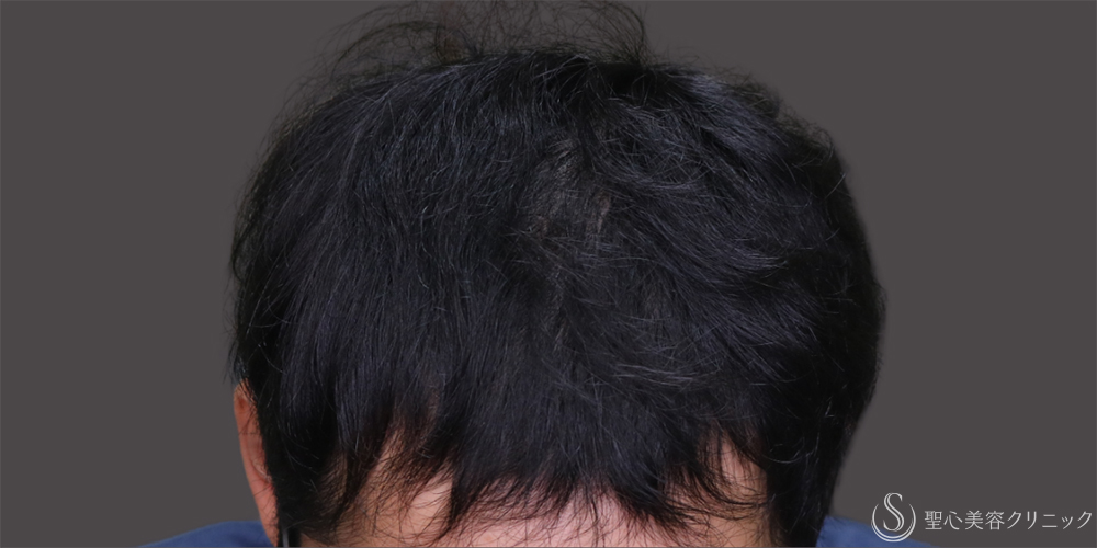 【30代男性・毛髪治療の長期経過】プレミアムグロースファクター再生療法＋デュタステリドAV＋ノキシジル内服（10ヶ月後～7年後） After 名古屋・AGA治療・発毛治療