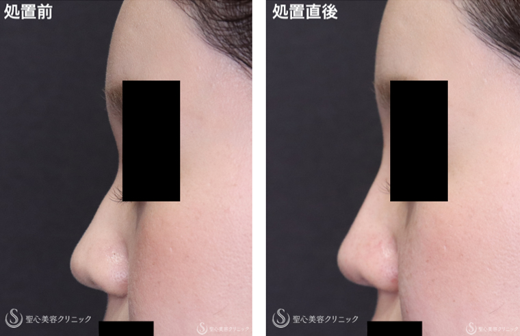 【20代女性・鼻筋と膜性鼻中隔への注入で美鼻に】ヒアルロン酸注入（鼻）（処置直後） After 