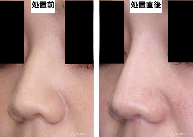 【20代女性・鼻筋と膜性鼻中隔への注入で美鼻に】ヒアルロン酸注入（鼻）（処置直後） Before 