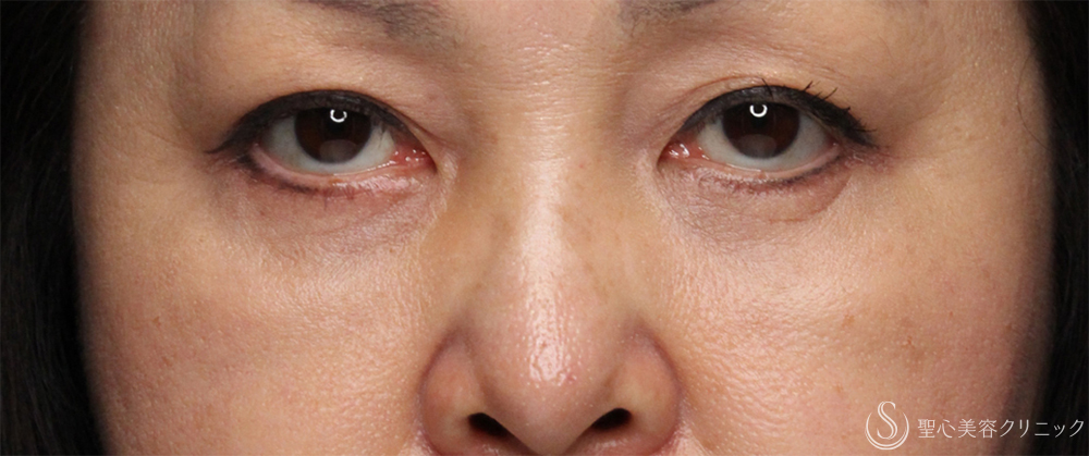 【50代女性・目の下のクマをスッキリ解消】下眼瞼切開術/下眼瞼除皺術/ハムラ法（術後1ヶ月） After 