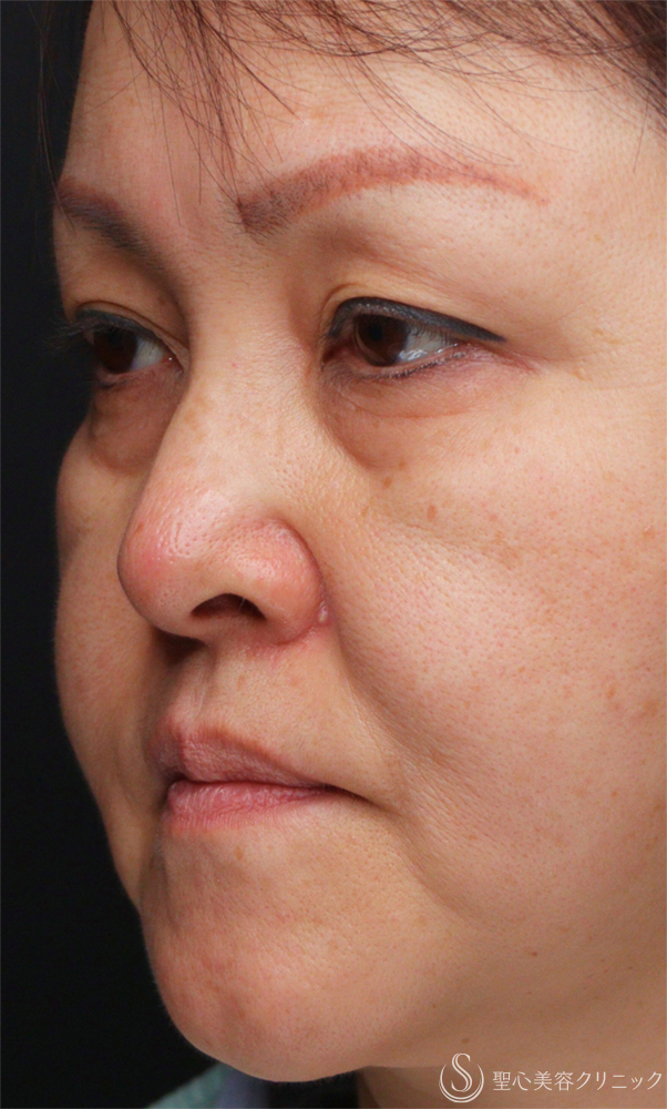 【50代女性・目の下のクマをスッキリ解消】下眼瞼切開術/下眼瞼除皺術/ハムラ法（術後1ヶ月） Before 