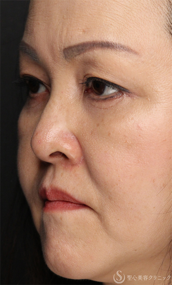 【50代女性・目の下のクマをスッキリ解消】下眼瞼切開術/下眼瞼除皺術/ハムラ法（術後1ヶ月） After 