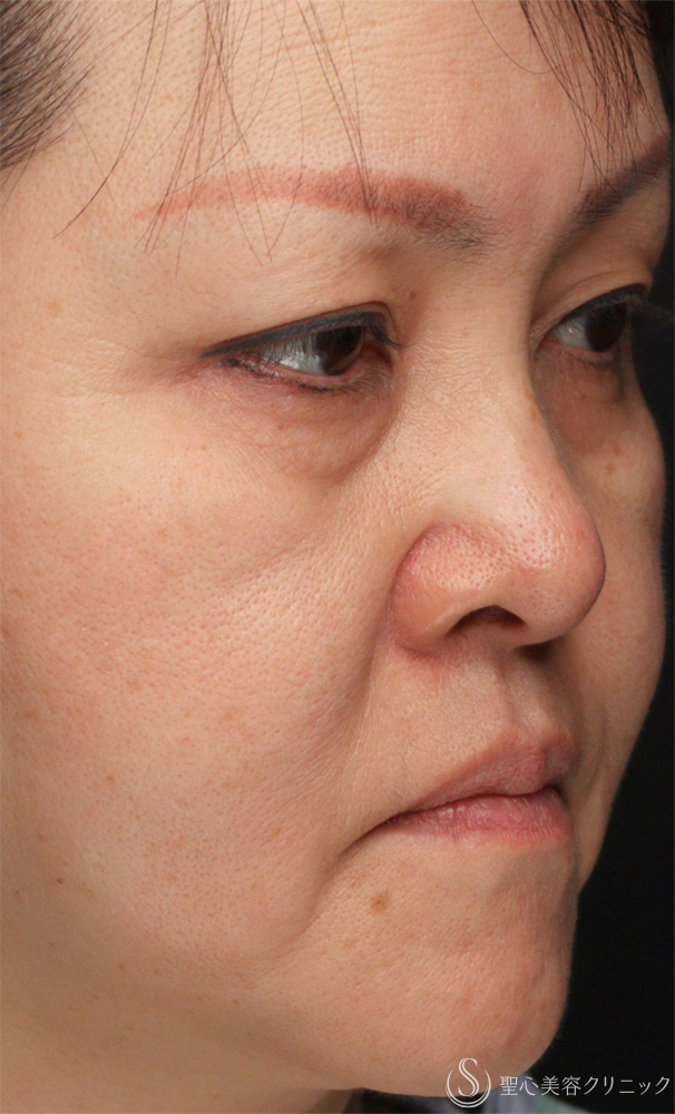 【50代女性・目の下のクマをスッキリ解消】下眼瞼切開術/下眼瞼除皺術/ハムラ法（術後1ヶ月） Before 