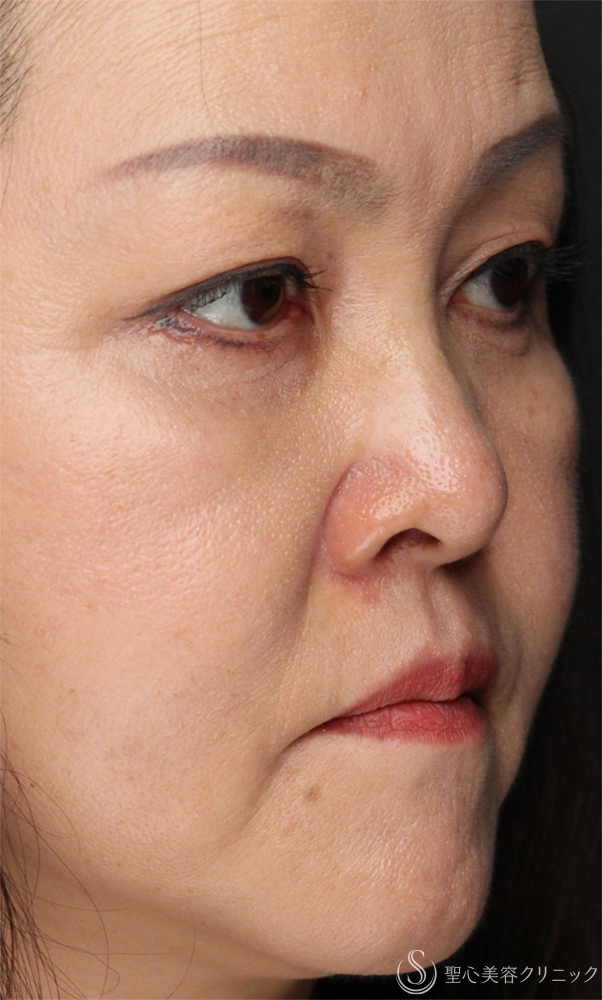 【50代女性・目の下のクマをスッキリ解消】下眼瞼切開術/下眼瞼除皺術/ハムラ法（術後1ヶ月） After 