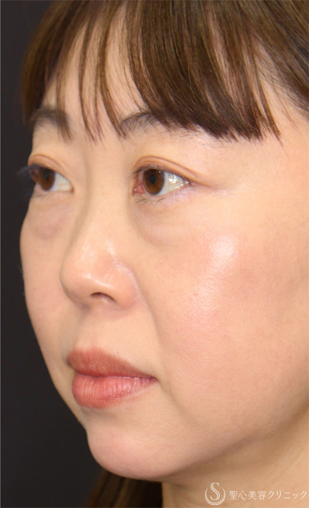 【40代女性・脂肪除去でクマを解消】下眼瞼除皺術＋眼窩脂肪除去（術後1ヶ月） Before 