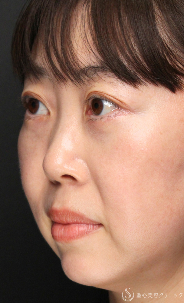 【40代女性・脂肪除去でクマを解消】下眼瞼除皺術＋眼窩脂肪除去（術後1ヶ月） After 