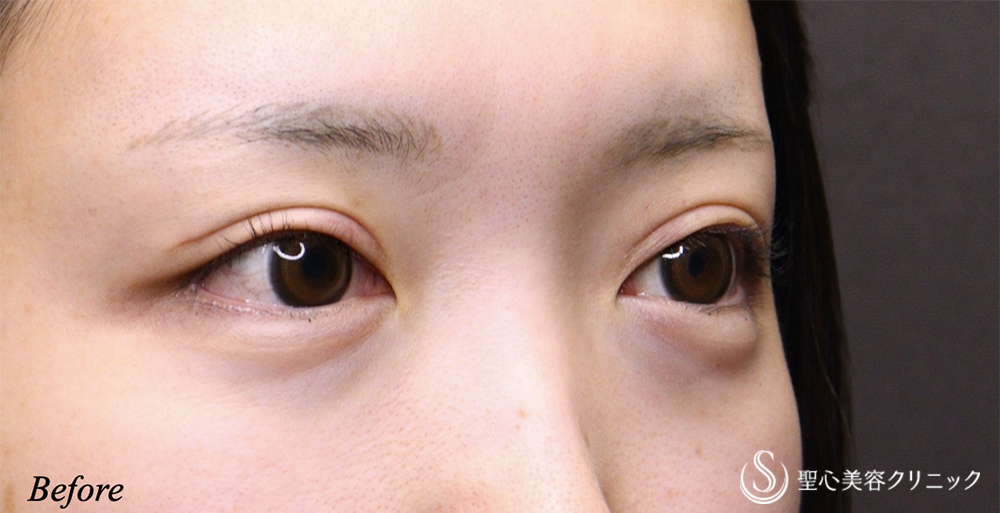【20代女性・ハム目を解消】睫毛上皮膚切除（1週間後） Before 